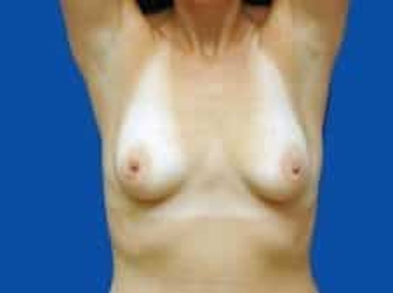 Breast Augmentation Before & After Gallery - Patient 285129 - Image 3