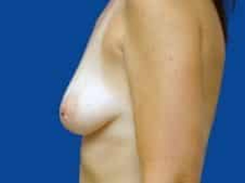 Breast Augmentation Before & After Gallery - Patient 285129 - Image 5