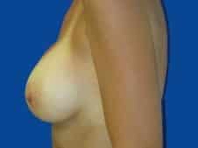 Breast Augmentation Before & After Gallery - Patient 285129 - Image 6