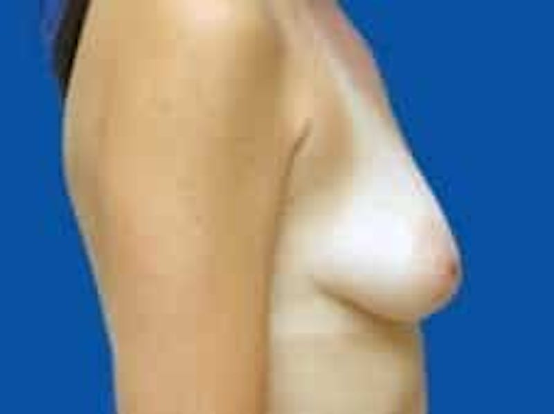 Breast Augmentation Before & After Gallery - Patient 285129 - Image 7