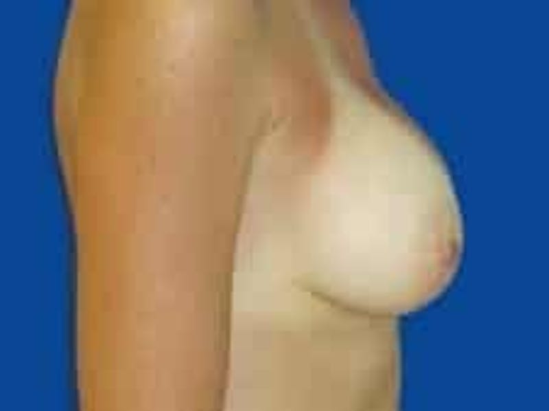 Breast Augmentation Before & After Gallery - Patient 285129 - Image 8