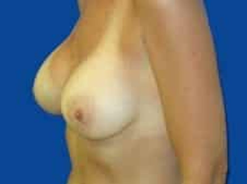 Breast Augmentation Before & After Gallery - Patient 285129 - Image 10