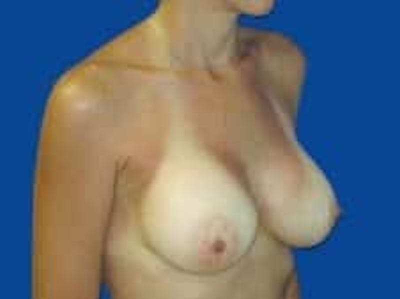 Breast Augmentation Before & After Gallery - Patient 285129 - Image 12