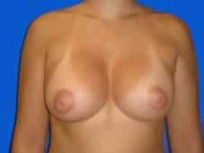 Breast Augmentation Before & After Gallery - Patient 306702 - Image 2