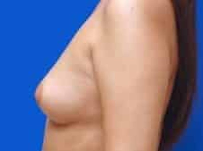Breast Augmentation Before & After Gallery - Patient 306702 - Image 3