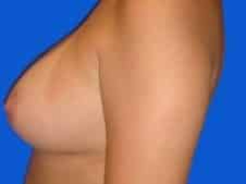 Breast Augmentation Before & After Gallery - Patient 306702 - Image 4