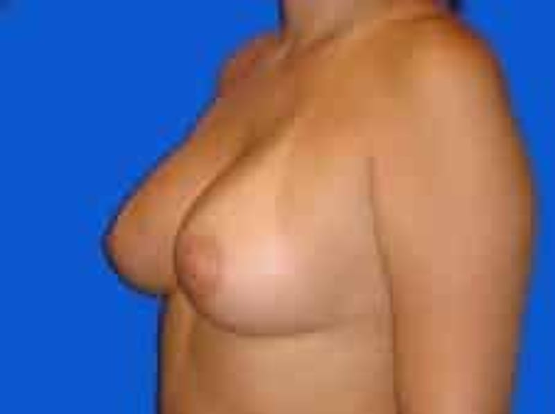 Breast Augmentation Before & After Gallery - Patient 306702 - Image 6