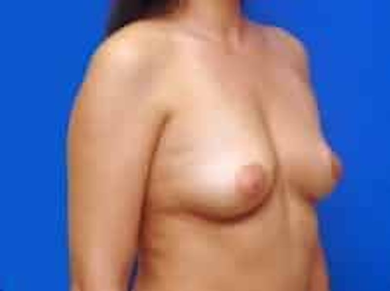 Breast Augmentation Before & After Gallery - Patient 306702 - Image 7