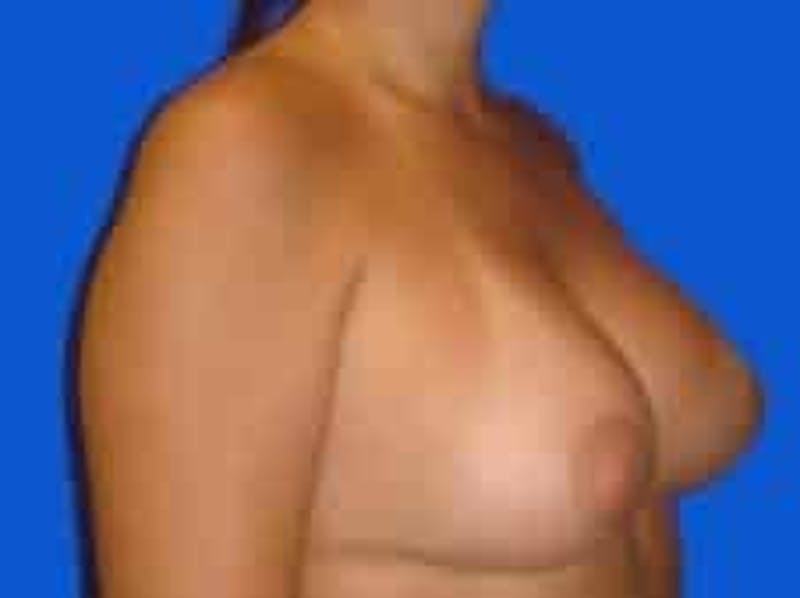 Breast Augmentation Before & After Gallery - Patient 306702 - Image 8