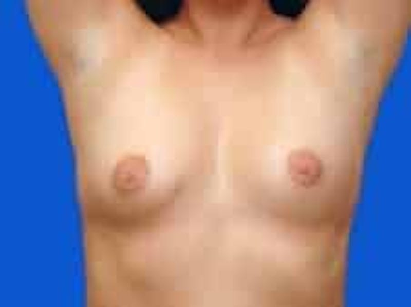 Breast Augmentation Before & After Gallery - Patient 306702 - Image 9