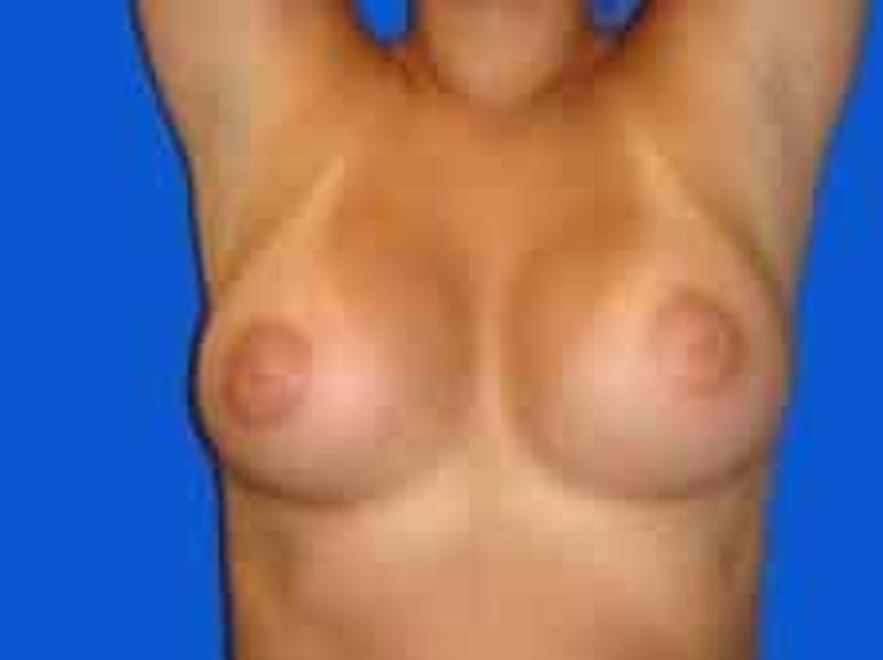 Breast Augmentation Before & After Gallery - Patient 306702 - Image 10