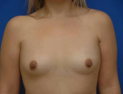 Breast Augmentation Before & After Gallery - Patient 233069 - Image 1