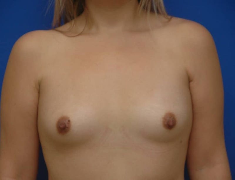 Breast Augmentation Before & After Gallery - Patient 233069 - Image 1