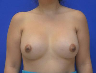 Breast Augmentation Before & After Gallery - Patient 233069 - Image 2