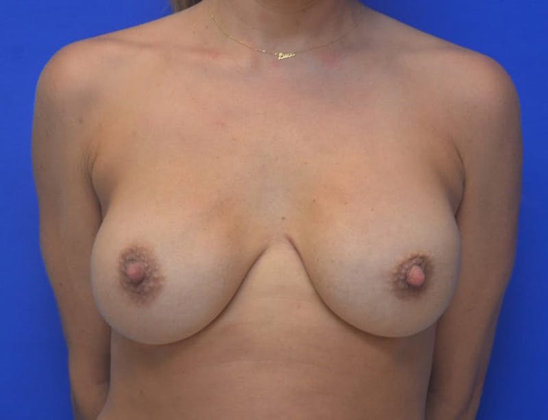 Breast Implant Exchange Before & After Gallery - Patient 267317 - Image 1