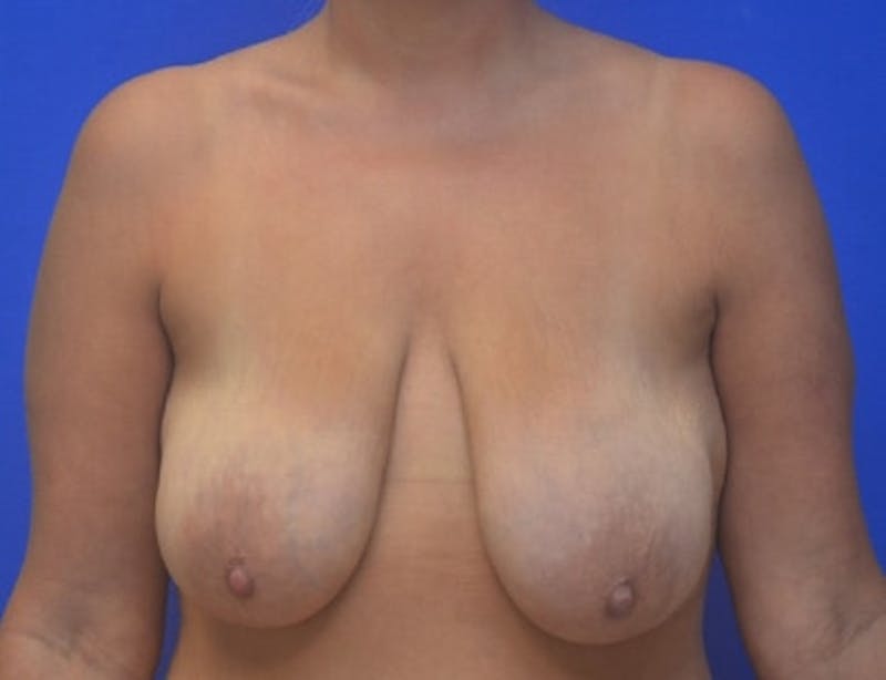 Breast Lift Before & After Gallery - Patient 209248 - Image 1