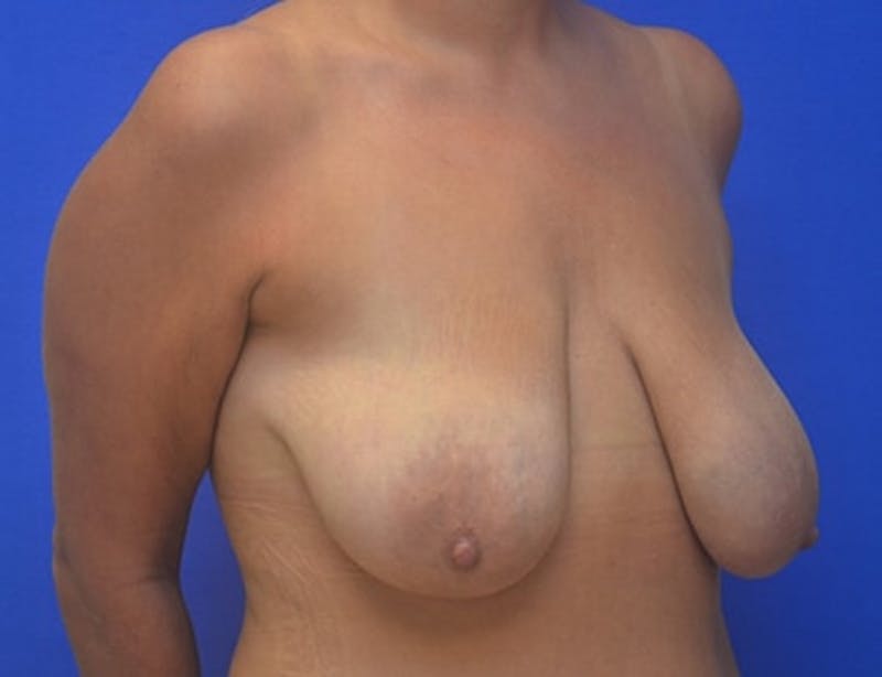 Breast Lift Before & After Gallery - Patient 209248 - Image 5
