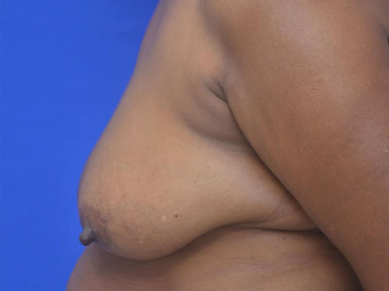 Breast Lift Before & After Gallery - Patient 283738 - Image 3