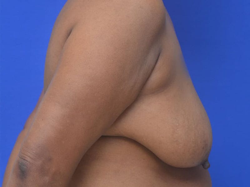 Breast Lift Before & After Gallery - Patient 283738 - Image 5