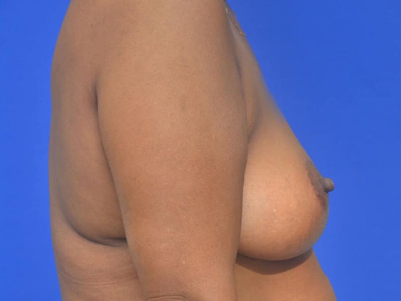 Breast Lift Before & After Gallery - Patient 283738 - Image 6