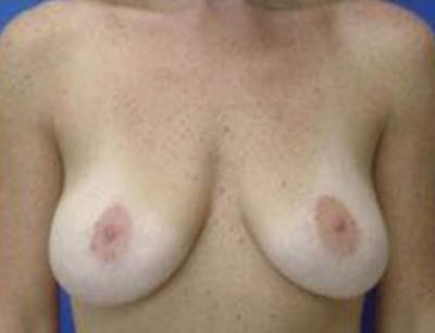 Breast Lift Before & After Gallery - Patient 221152 - Image 1
