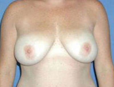 Breast Lift Before & After Gallery - Patient 221152 - Image 2