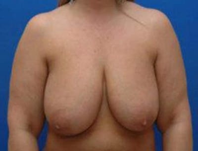 Breast Lift Before & After Gallery - Patient 141918 - Image 1