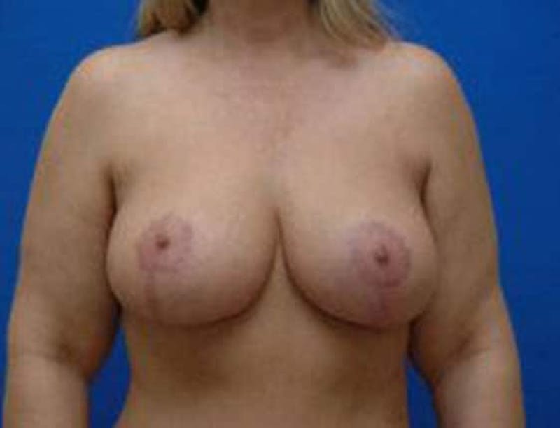 Breast Lift Before & After Gallery - Patient 141918 - Image 2