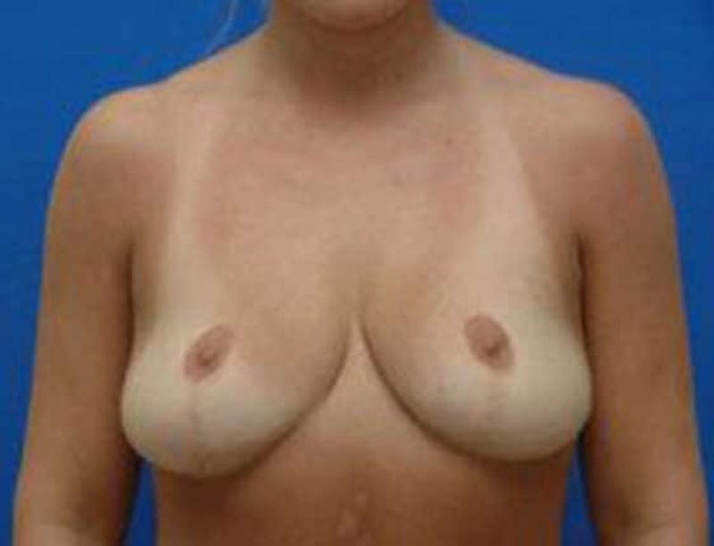 Breast Lift Before & After Gallery - Patient 576968 - Image 1