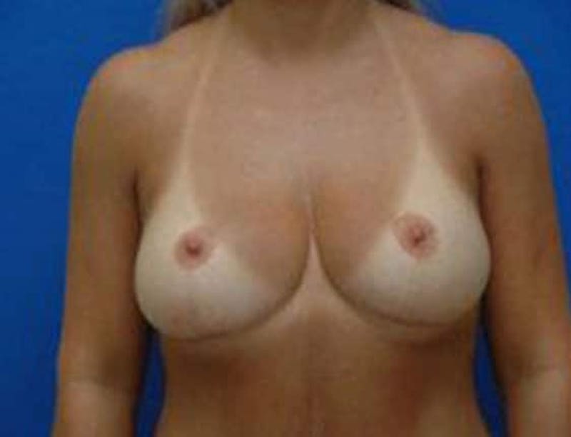 Breast Lift Before & After Gallery - Patient 576968 - Image 2