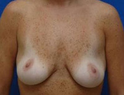 Breast Lift Before & After Gallery - Patient 145604 - Image 1