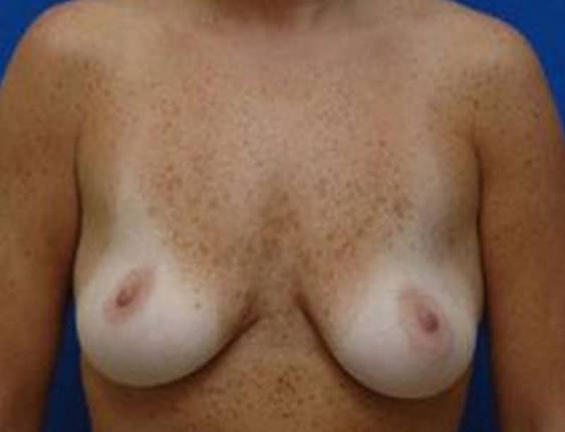 Breast Lift Before & After Gallery - Patient 145604 - Image 1