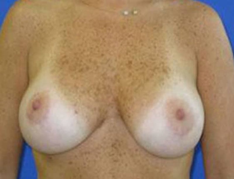 Breast Lift Before & After Gallery - Patient 145604 - Image 2
