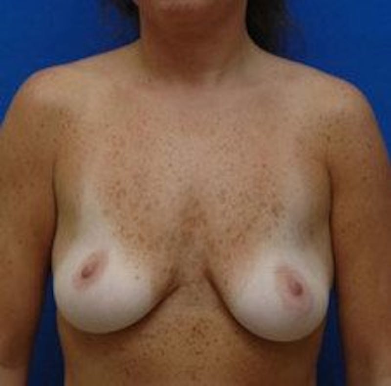 Breast Lift Before & After Gallery - Patient 145604 - Image 5