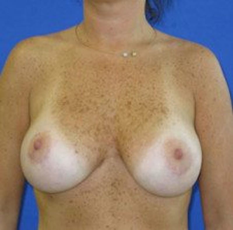 Breast Lift Before & After Gallery - Patient 145604 - Image 6