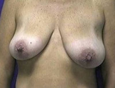 Breast Lift Before & After Gallery - Patient 167146 - Image 1