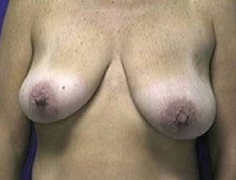 Breast Lift Before & After Gallery - Patient 167146 - Image 1