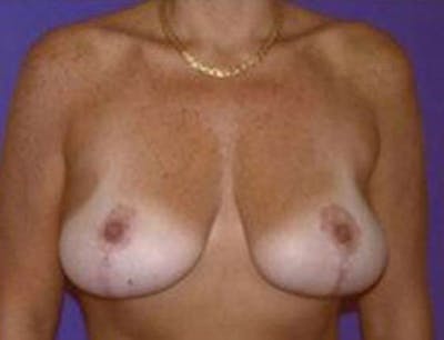 Breast Lift Before & After Gallery - Patient 167146 - Image 2