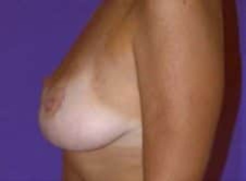 Breast Lift Before & After Gallery - Patient 167146 - Image 4