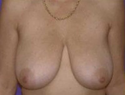 Breast Lift Before & After Gallery - Patient 792270 - Image 1