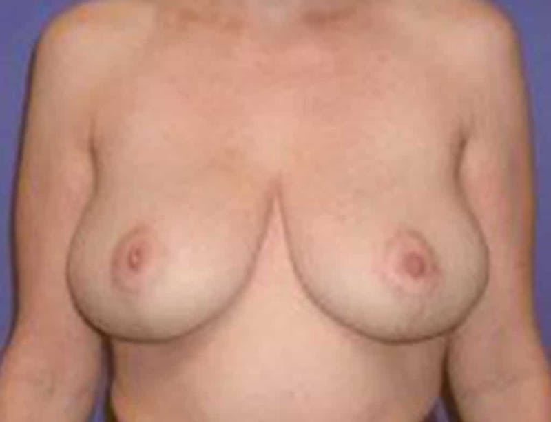 Breast Lift Before & After Gallery - Patient 792270 - Image 2