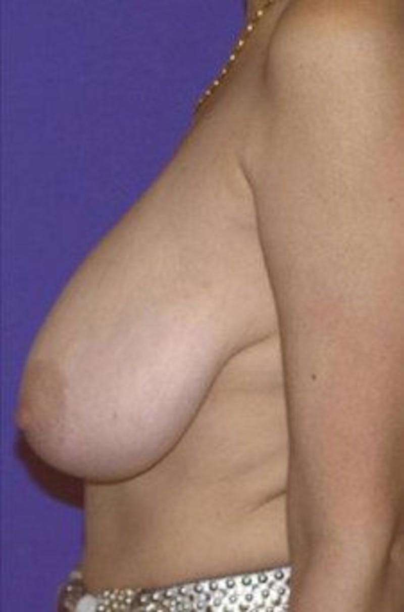 Breast Lift Before & After Gallery - Patient 792270 - Image 3