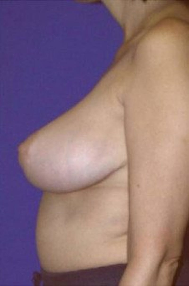 Breast Lift Before & After Gallery - Patient 792270 - Image 4