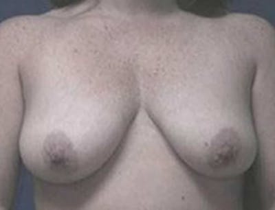 Breast Lift Before & After Gallery - Patient 199315 - Image 1