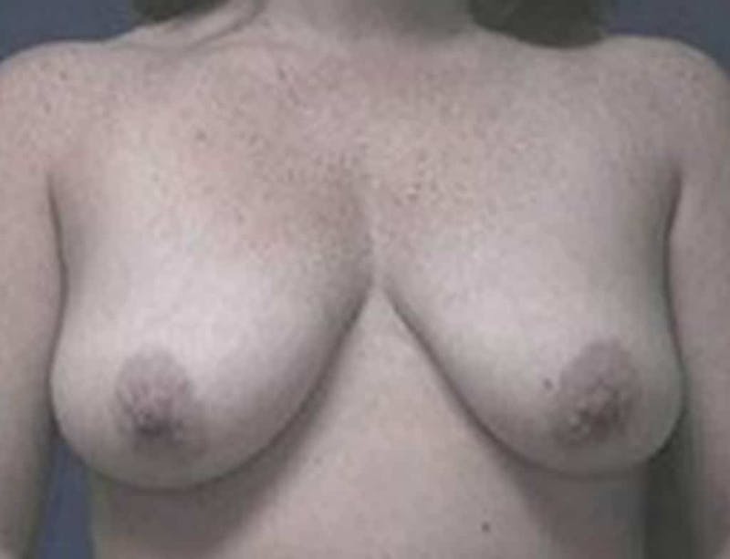 Breast Lift Before & After Gallery - Patient 199315 - Image 1