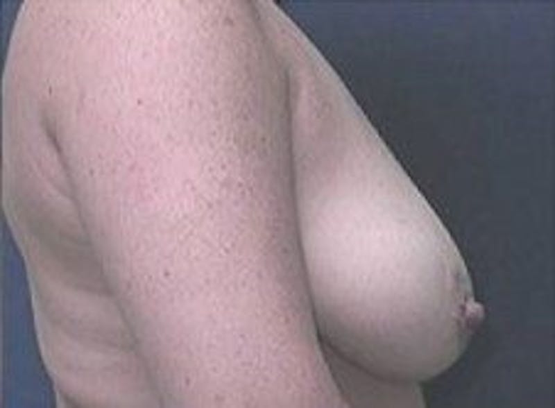 Breast Lift Before & After Gallery - Patient 199315 - Image 3
