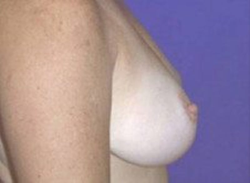 Breast Lift Before & After Gallery - Patient 199315 - Image 4
