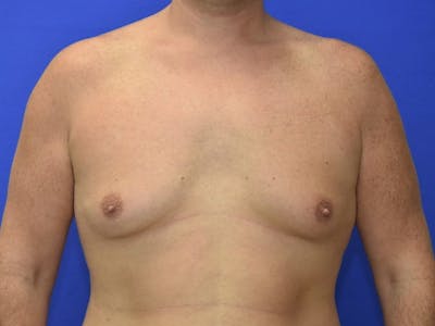 Gynecomastia Before & After Gallery - Patient 534593 - Image 1