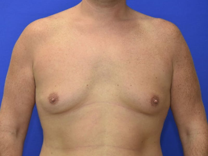 Gynecomastia Before & After Gallery - Patient 534593 - Image 1