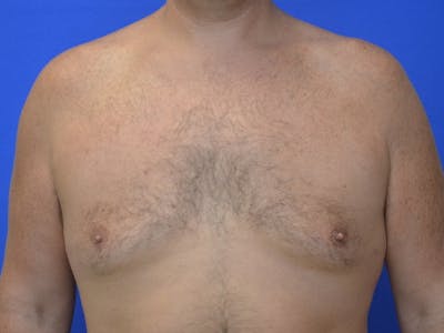 Gynecomastia Before & After Gallery - Patient 534593 - Image 2